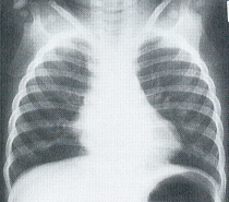 感染性肺疾患
