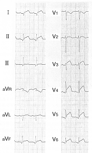 急性心膜炎の心電図（広範なST上昇）